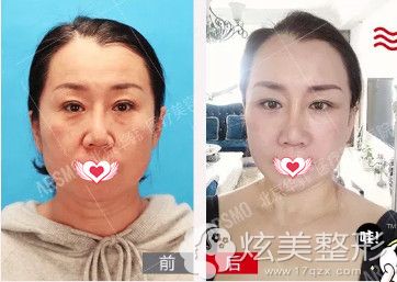 柳民熙院长做埋线提升案例 柳民熙院长做埋线提升案例