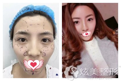 张淑艳医生做自体脂肪填充面部案例 张淑艳医生做自体脂肪填充面部案例