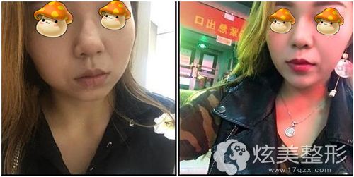 月月到长沙美莱做4D全鼻重塑术后恢复效果 月月到长沙美莱做4D全鼻重塑术后恢复效果