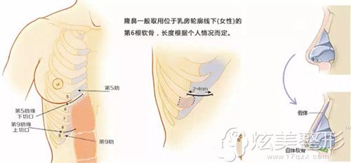 韩国DI整形医院做自体软骨隆鼻手术 韩国DI整形医院做自体软骨隆鼻手术