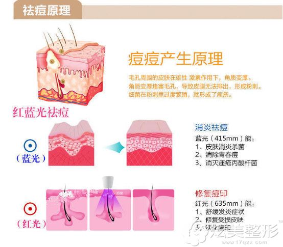 西安同安济医院推出红蓝光联合祛痘 西安同安济医院推出红蓝光联合祛痘
