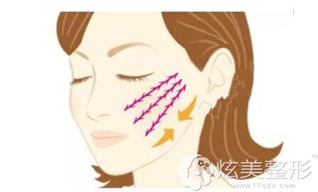 线雕后还是应该尽量控制自己的情绪 线雕后还是应该尽量控制自己的情绪