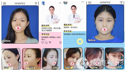 李光琴院长做鼻综合整形<span alt=