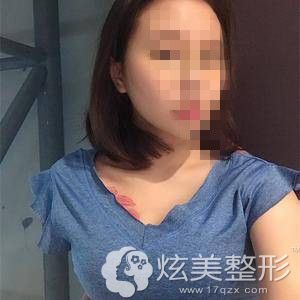 贵阳美贝尔宋俊辉假体丰胸8天 贵阳美贝尔宋俊辉假体丰胸8天