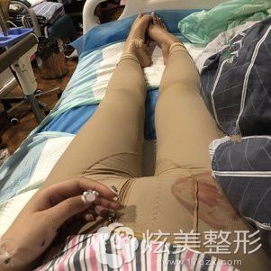 认准西安刘晨院长大腿吸脂2700ml术后从短粗腿到大长腿