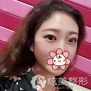 到济南优莱美做全切双眼皮眼综合术后56天恢复效果 到济南优莱美做全切双眼皮眼综合术后56天恢复效果