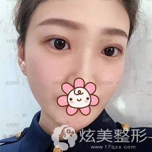 王霄然医生帮做全切双眼皮眼综合术后20天肿胀消除 王霄然医生帮做全切双眼皮眼综合术后20天肿胀消除