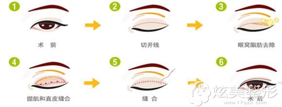 肿眼泡做切开双眼皮手术原理 肿眼泡做切开双眼皮手术原理