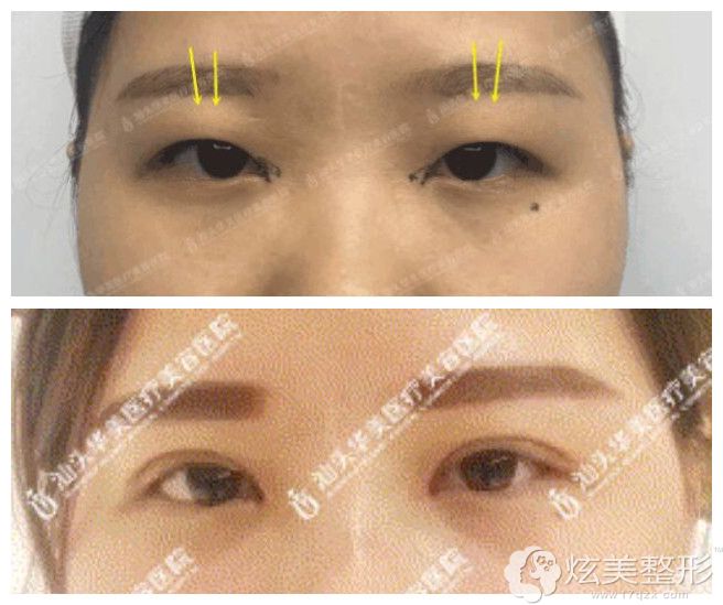 脂肪型肿泡眼在汕头华美做双眼皮案例 脂肪型肿泡眼在汕头华美做双眼皮案例