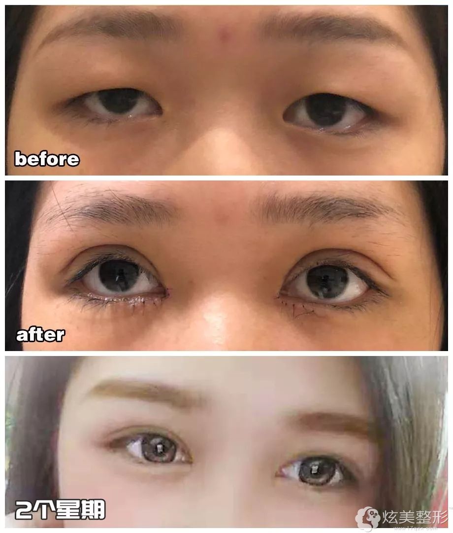 肌肉型肿泡眼在汕头华美做双眼皮 肌肉型肿泡眼在汕头华美做双眼皮
