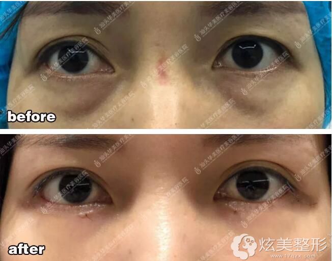 上睑松弛型肿泡眼在汕头华美做双眼皮案例 上睑松弛型肿泡眼在汕头华美做双眼皮案例