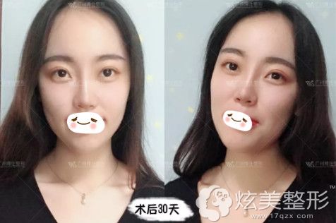 在广州博仕做线雕隆鼻失败修复术后1个月恢复自然 在广州博仕做线雕隆鼻失败修复术后1个月恢复自然