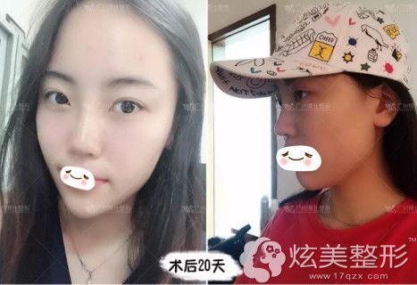 李帅敏医生为我做鼻综合整形修复术后20天已经消肿 李帅敏医生为我做鼻综合整形修复术后20天已经消肿