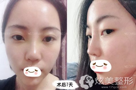 在广州博仕做线雕隆鼻失败修复术后7天进行拆线 在广州博仕做线雕隆鼻失败修复术后7天进行拆线
