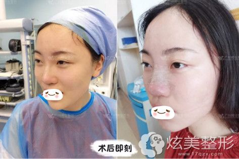 李帅敏医生为我做隆鼻失败修复手术即刻效果 李帅敏医生为我做隆鼻失败修复手术即刻效果