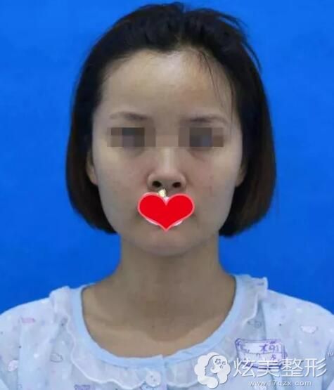 了解朝天鼻的三种整形方法后在新疆千禧丽人做鼻综合改善