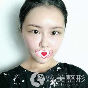 杜亚旭医生刚做完面部填充手术后面部微肿 杜亚旭医生刚做完面部填充手术后面部微肿