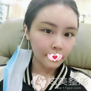 在重庆铂生做全脸脂肪填充第5天消肿的照片 在重庆铂生做全脸脂肪填充第5天消肿的照片