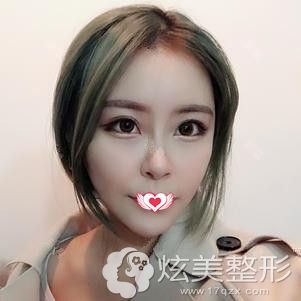杜亚旭医生为我做面部脂肪填充术后18天完全消肿 杜亚旭医生为我做面部脂肪填充术后18天完全消肿