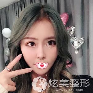 在重庆铂生做脂肪填充面部术后2个月恢复自然 在重庆铂生做脂肪填充面部术后2个月恢复自然