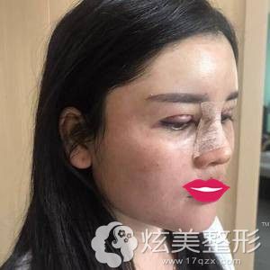 �ŷ�ҽ��Ϊ�Ҹ������۱��ۺϺ��沿֬����������沿����