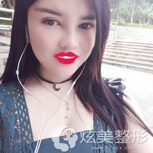 �ŷ�ҽ��Ϊ�����۱��ۺϺ�֬������沿1���º��Ѿ�����