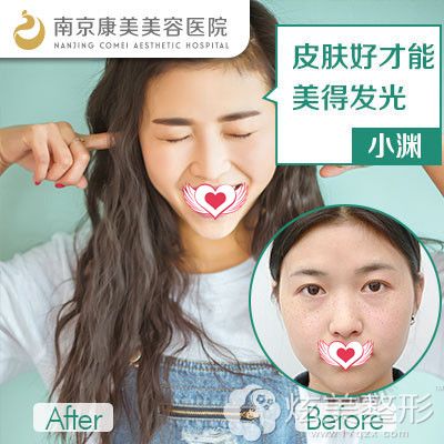 康美整形超皮秒激光祛斑案例 康美整形超皮秒激光祛斑案例
