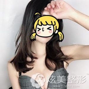 在杭州美莱做曼托假体隆胸术后15天完全消肿 在杭州美莱做曼托假体隆胸术后15天完全消肿