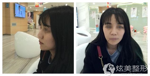 面诊重庆联合丽格术前鼻子塌鼻头大 面诊重庆联合丽格术前鼻子塌鼻头大