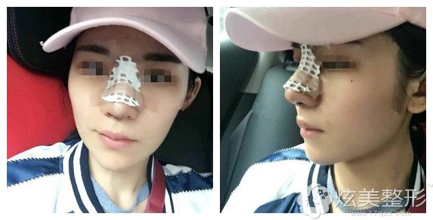 刚做完鼻综合术后样子 刚做完鼻综合术后样子
