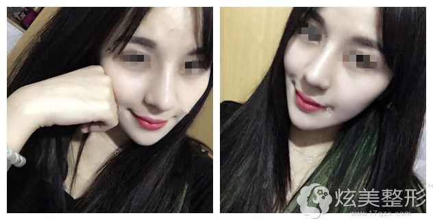 术后一周拆线鼻子恢复情况 术后一周拆线鼻子恢复情况