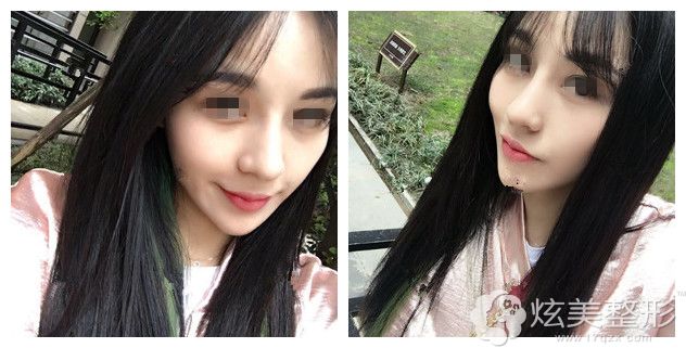 半个月后肋软骨鼻综合恢复 半个月后肋软骨鼻综合恢复