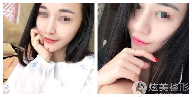 到重庆联合丽格做肋软骨鼻综合术后效果 到重庆联合丽格做肋软骨鼻综合术后效果