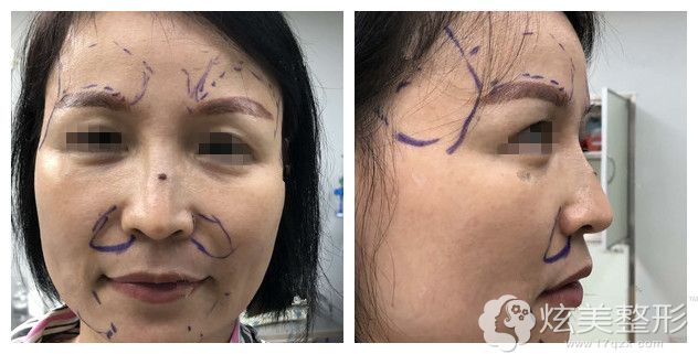 术前面部凹陷下垂面诊深圳格美医生 术前面部凹陷下垂面诊深圳格美医生