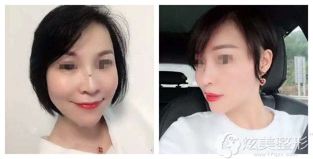 到深圳格美做小切口面部提升术后效果 到深圳格美做小切口面部提升术后效果
