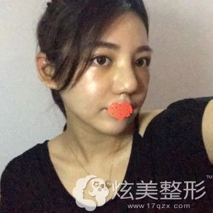 殷运成医生为我做鼻综合术后7天进行拆线 殷运成医生为我做鼻综合术后7天进行拆线