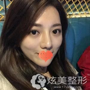 在汕头曙光做鼻综合术后15天鼻子基本消肿 在汕头曙光做鼻综合术后15天鼻子基本消肿
