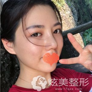 殷运成医生为我做鼻综合术后25天肿胀完全消除 殷运成医生为我做鼻综合术后25天肿胀完全消除