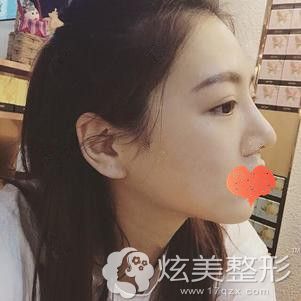在汕头曙光做鼻综合术后2个月恢复自然 在汕头曙光做鼻综合术后2个月恢复自然