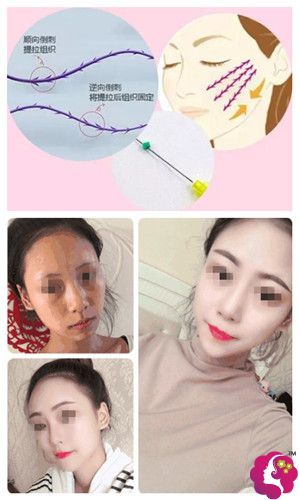 杭州薇琳做恒生PPDO线雕提升案例 杭州薇琳做恒生PPDO线雕提升案例