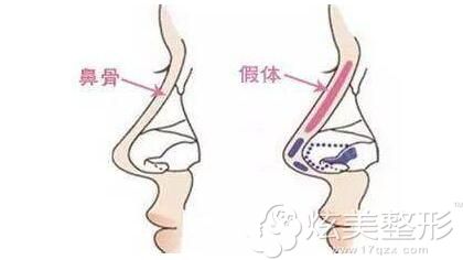 鼻子发生歪斜 鼻子发生歪斜