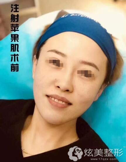 面诊顺德壹加壹术前苹果肌不明显 面诊顺德壹加壹术前苹果肌不明显