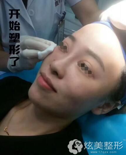 玻尿酸注射后还需要加以塑形得到苹果肌 玻尿酸注射后还需要加以塑形得到苹果肌
