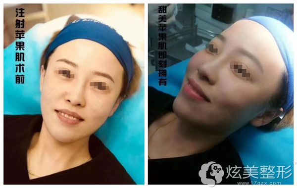 在顺德壹加壹注射玻尿酸丰苹果肌术后效果 在顺德壹加壹注射玻尿酸丰苹果肌术后效果