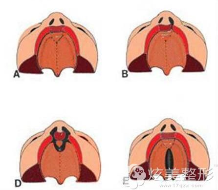 婴儿隐性唇裂 婴儿隐性唇裂