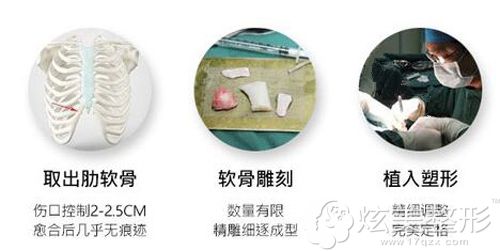 薇琳整形做鼻部综合整形手术步骤简易图 薇琳整形做鼻部综合整形手术步骤简易图