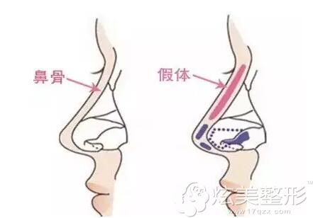 肖庆华医生提出鼻炎发生范围和隆鼻手术范围是不同 肖庆华医生提出鼻炎发生范围和隆鼻手术范围是不同
