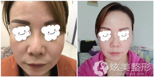 南京华美做埋线提升术后15天改善效果明显 南京华美做埋线提升术后15天改善效果明显