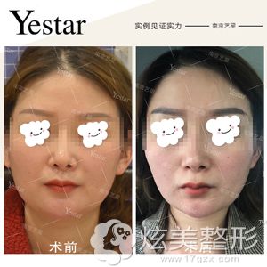 艺星辛海龙院长做埋线提升下颌缘变清晰 艺星辛海龙院长做埋线提升下颌缘变清晰