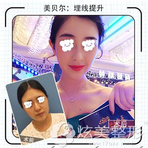 南京美贝尔做埋线提升改变初老现象 南京美贝尔做埋线提升改变初老现象